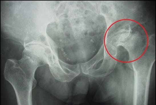 Thoái hóa đốt sống lưng