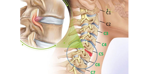Thoát vị đĩa đệm và thoái hóa đốt sống cổ