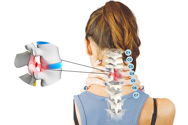 Việc điều trị thoái hóa đốt sống cổ có thể gặp nhiều khó khăn