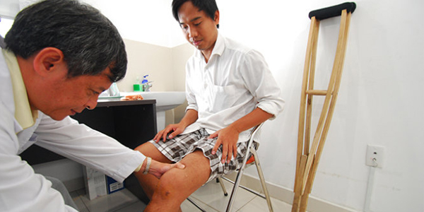 Biến dạng bàn tay gió thổi trong viêm khớp dạng thấp
