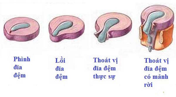 Phồng đĩa đệm dẫn tới thoát vị đĩa đệm như thế nào?