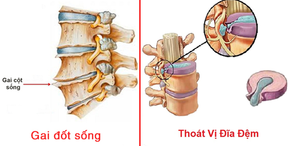 Gai cột sống có hình dáng giống như những mỏm gai