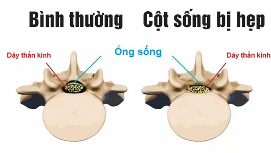 Đau thần kinh tọa